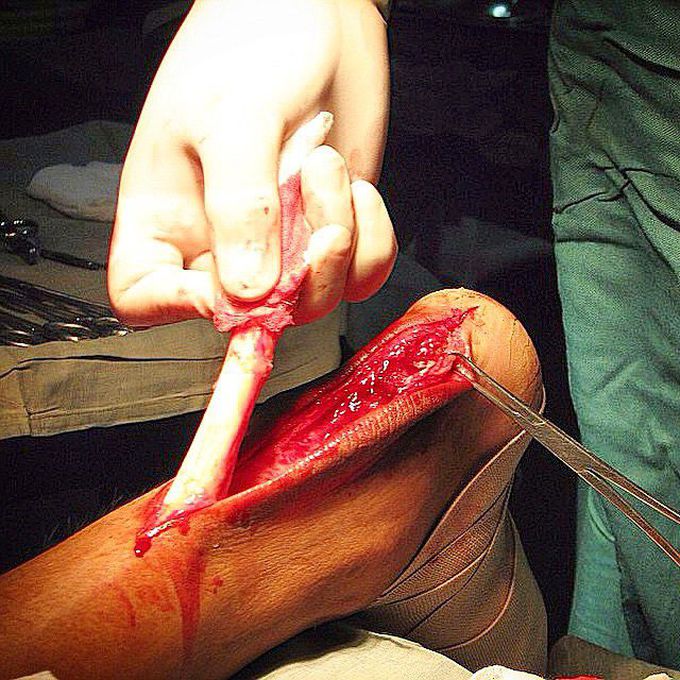 Surgical reconstruction of the Achilles' tendon!