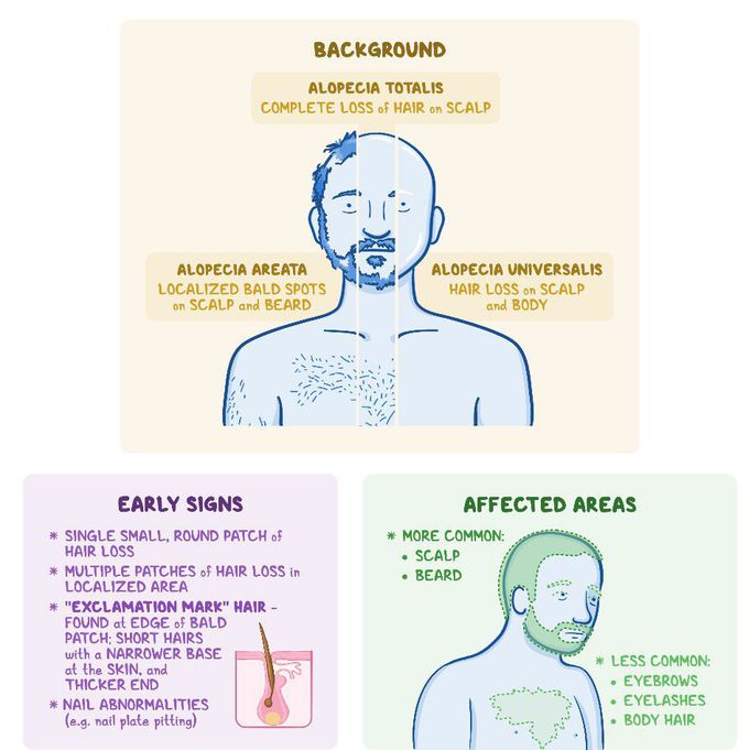 Symptom of Alopecia totalis