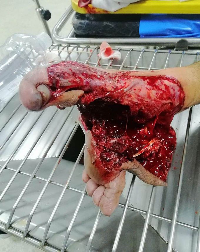 MANGLED FOOT