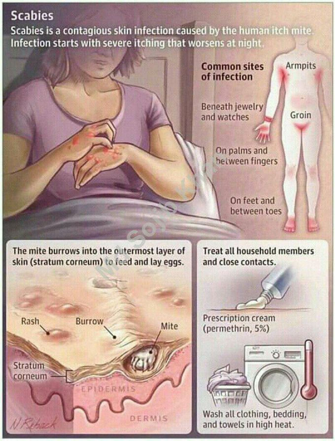 scabies burrows