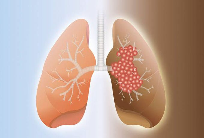 Causes of pulmonary fibrosis