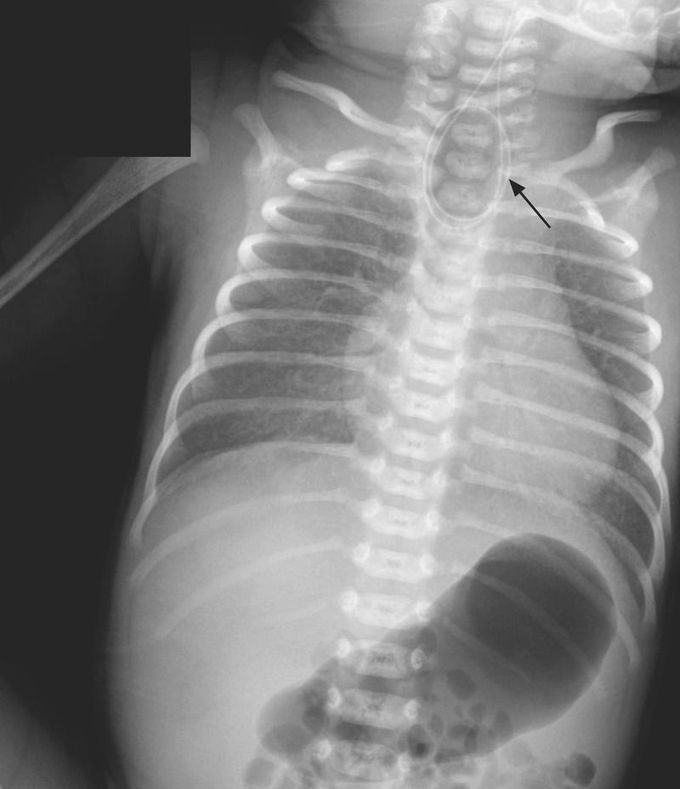 Esophageal Atresia and Tracheoesophageal Fistula