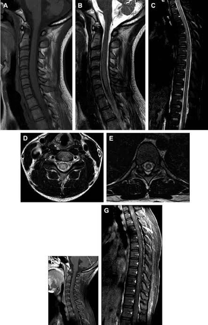 Baggio yoshinari syndrome symptoms