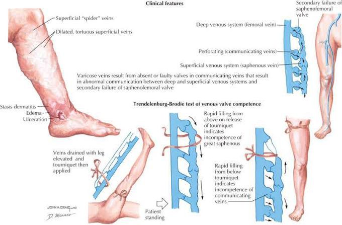 Trendelenburg Test for Varicose veins