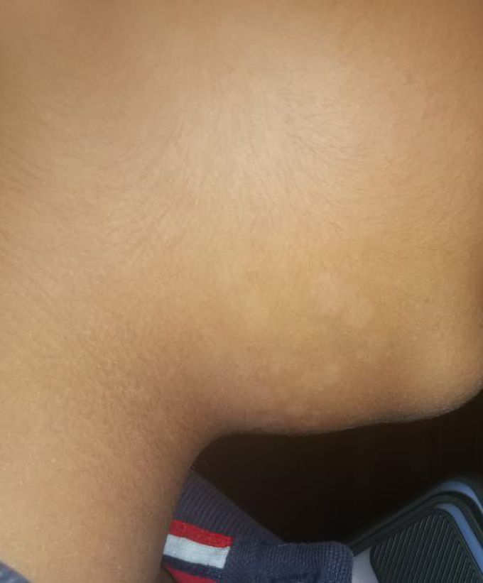 Pityriasis Alba