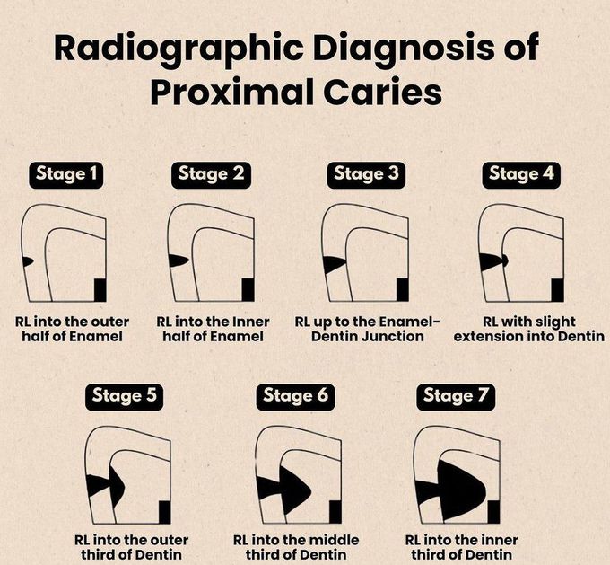Radiographic Diagnosis of Proximal Caries