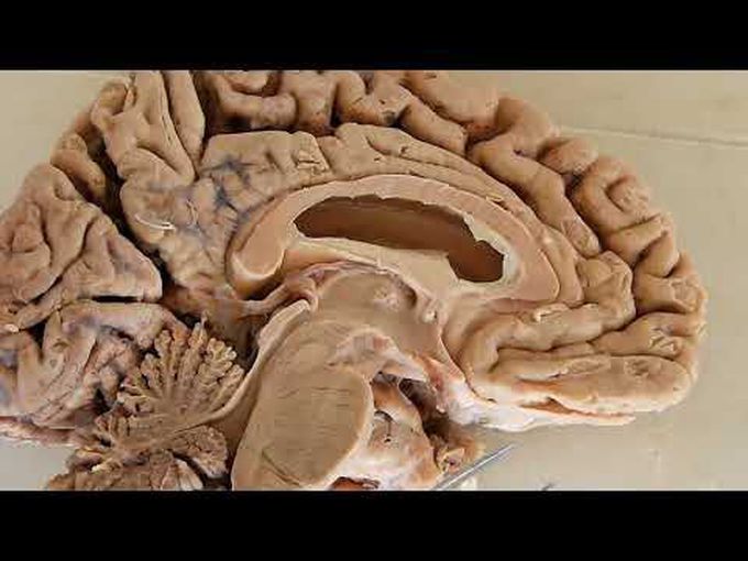 Anatomy of the Third Ventricle