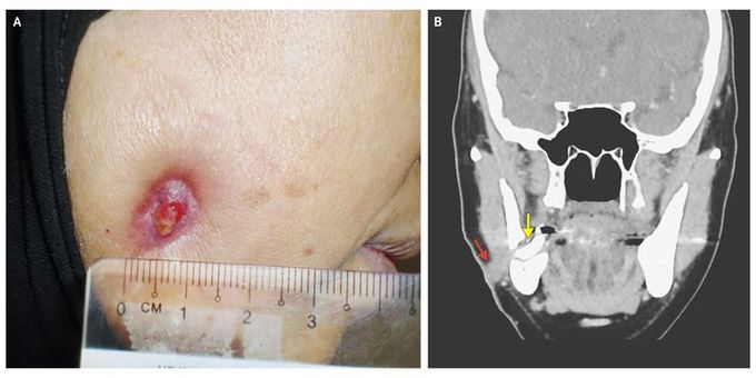 Discharging Dental Sinus Tract