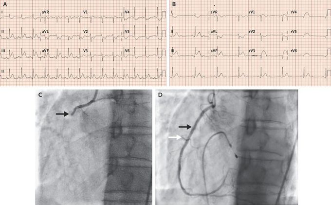 Right Ventricular Infarction