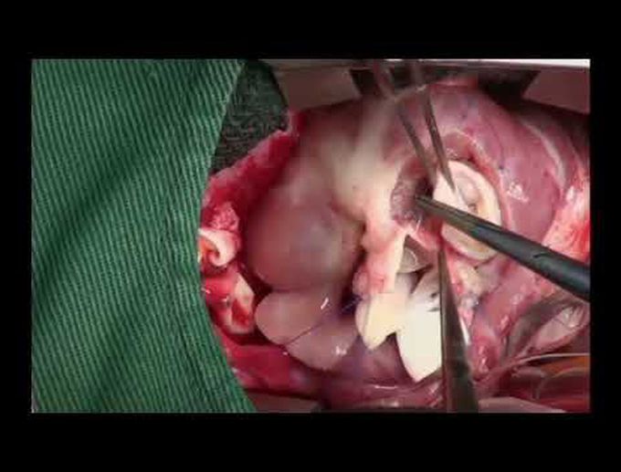 Half-Turned Truncal Switch Operation for Transposition of the Great Arteries