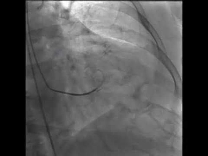 Takotsubo Cardiomyopathy