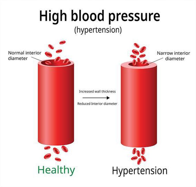 How to diagnose hypertension