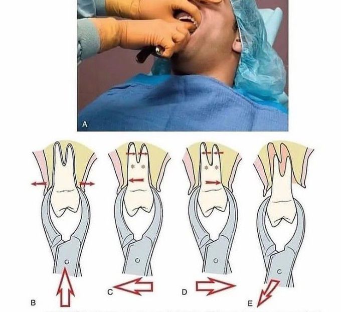 Forceps position for Maxillary Premolar extraction