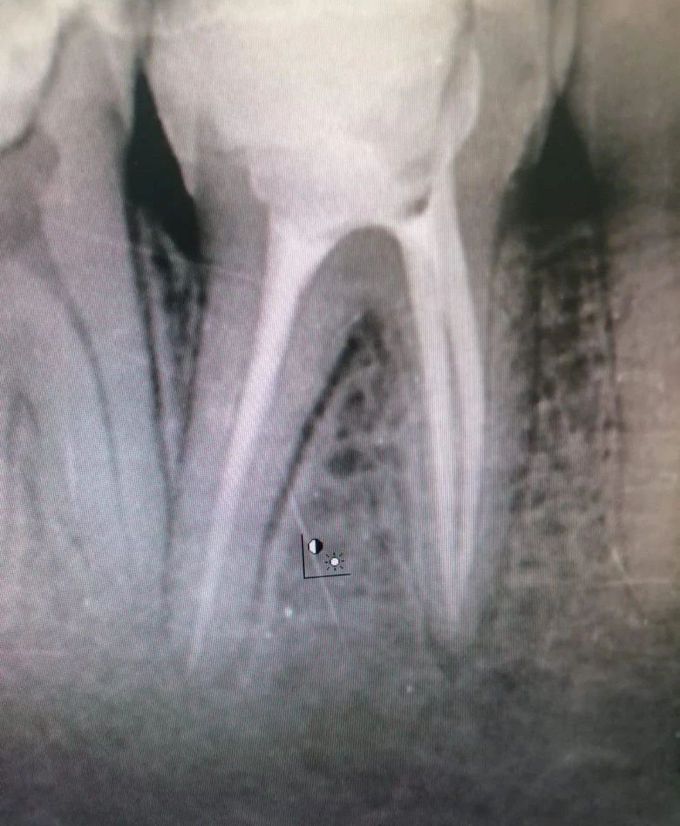 Root Canal Treatment