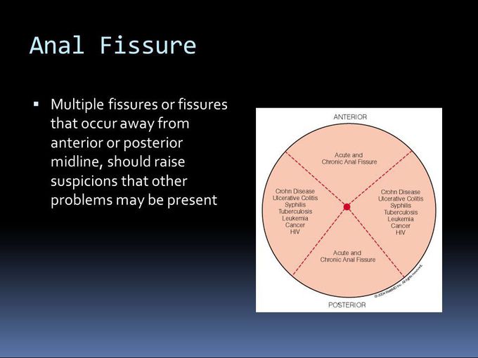 Anal fissure
