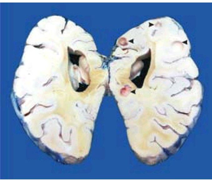 Neurocysticercosis