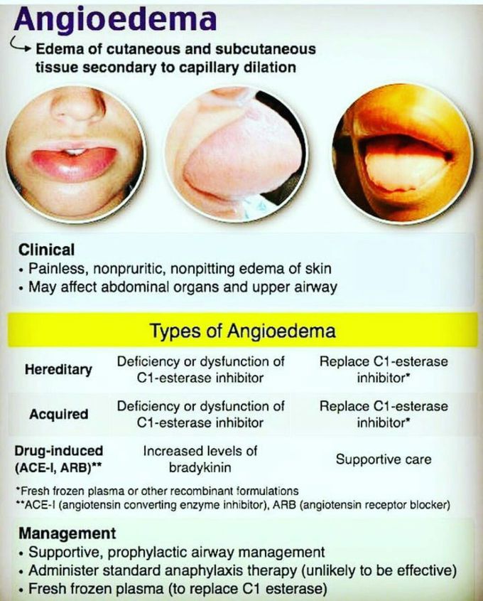 Angioedema - MEDizzy