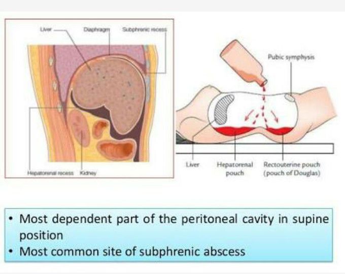 Hepatorenal pouch or Morrison's pouch