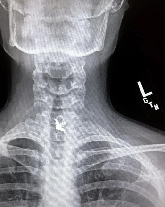 AIRWAY OBSTRUCTION