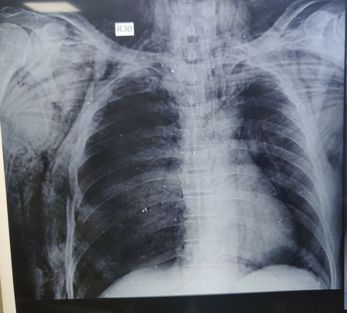 Subcutaneous Emphysema