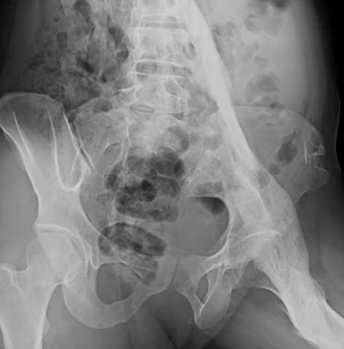 Fibrodysplasia ossificans progressiva