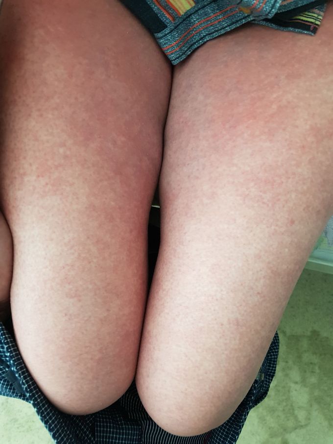 Diagnosis? Skin lesions with tonsilitis