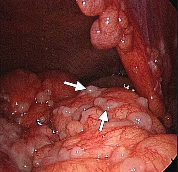 Disseminated carcinomatosis