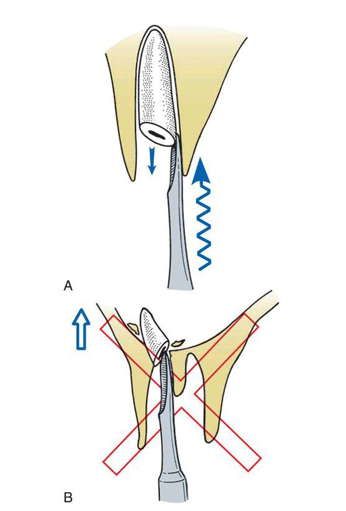 Retrieval of large root