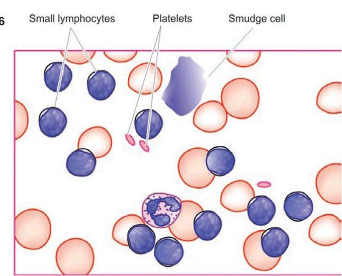 Chronic lymphocytic leukaemia (CLL).