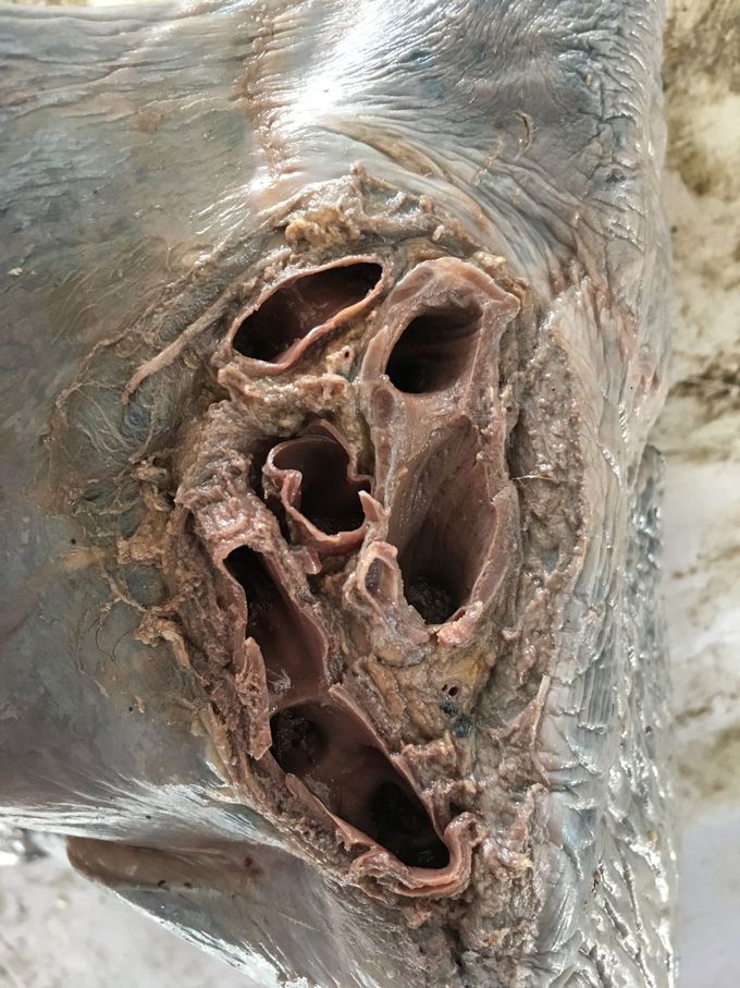 Root of lung