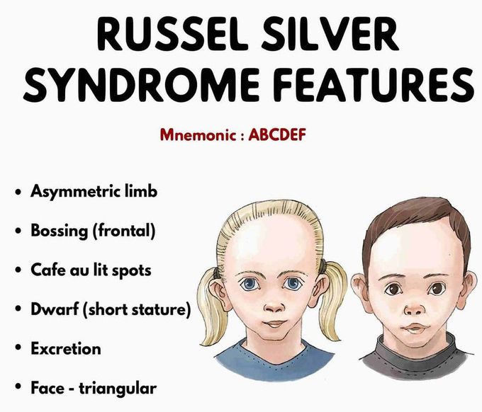 Russel Silver Syndrome- Features