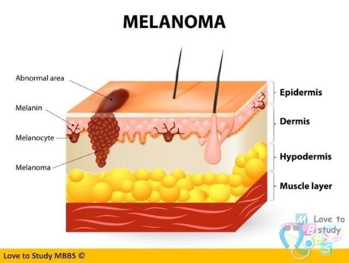 Melanoma