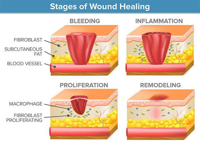 Stages of Wound Healing