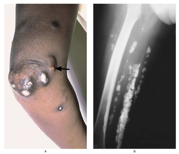 Calcifications in Dermatomyositis