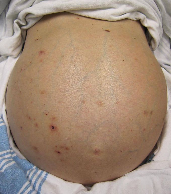 Abdomen of a patient with cirrhosis