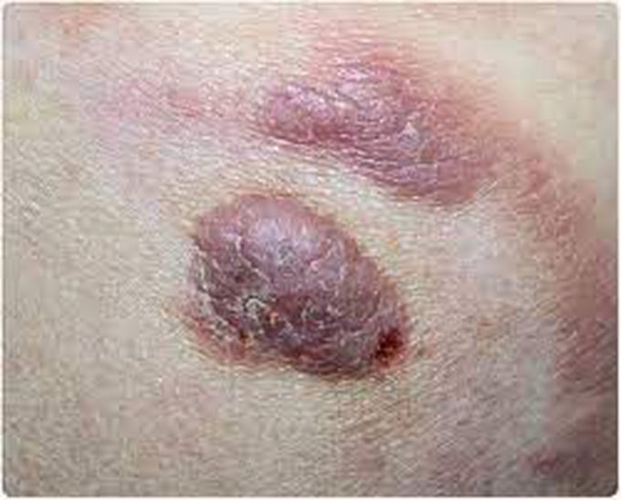 Treatment of cutaneous t-cell lymphoma