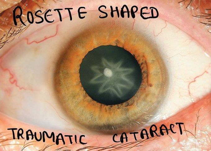 Rosette shaped Cataract