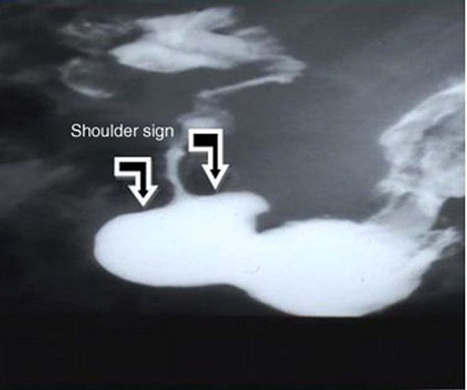 What is shoulder sign?