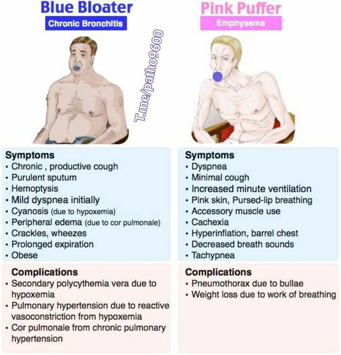 Respiratory diseases