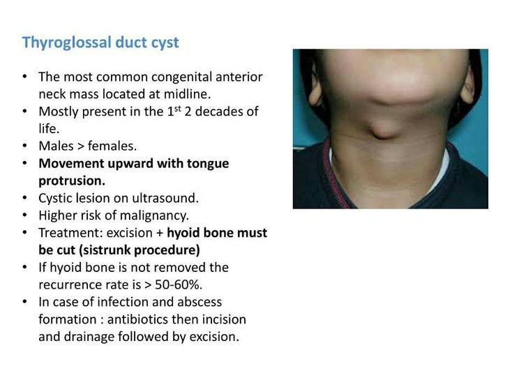 Thyroglossal Duct Cyst Medizzy