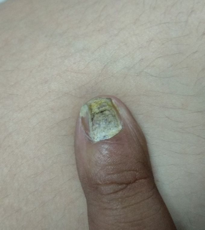 This is 4 years old case. Ever growing. Can you tell what to do