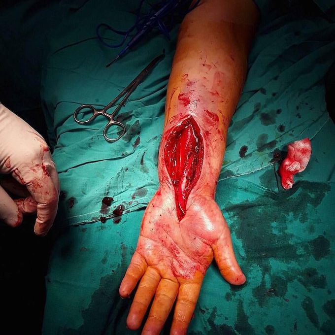 Upper limb fasciotomy