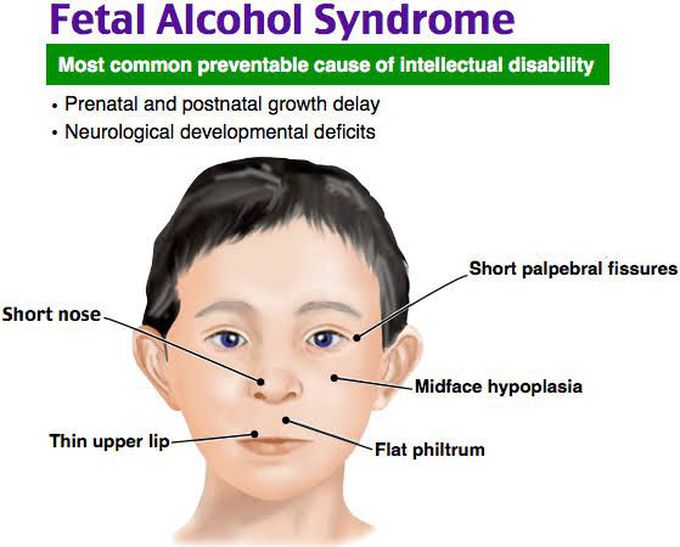 Fetal Alcohol Syndrome - MEDizzy