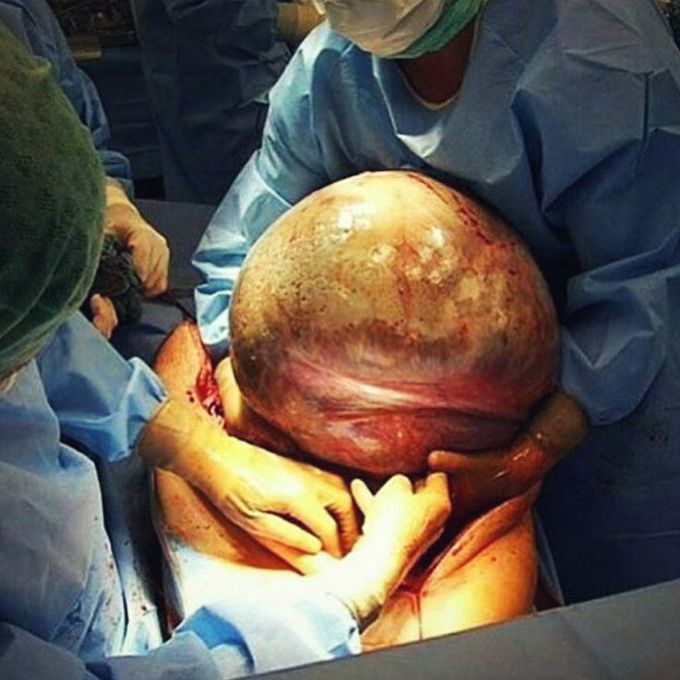 Cyst
