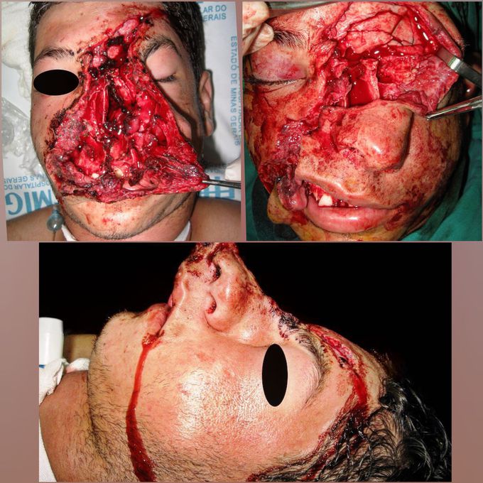 Case sequence (maxillofacialsurgery)