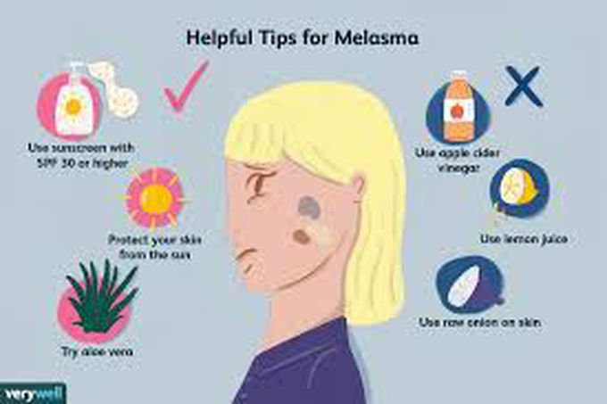 Melasma treatment