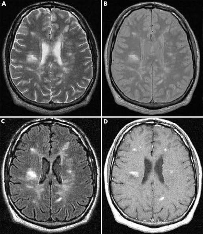 Multiple sclerosis (MS)
