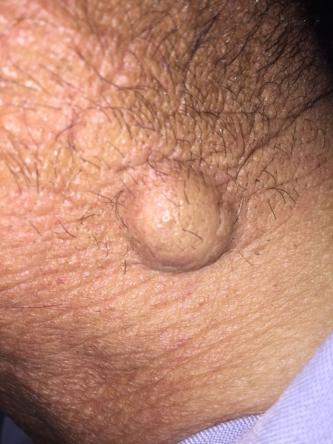 A 65 years old male appeared this drop 4 month ago , what is your diagnosis???