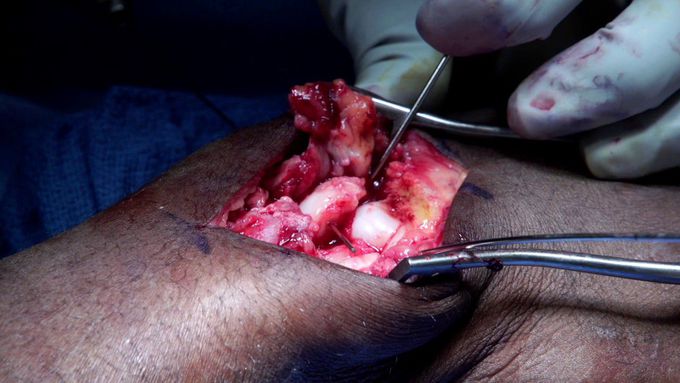 Perilunate dislocations--A SLIC speedy solution without wires