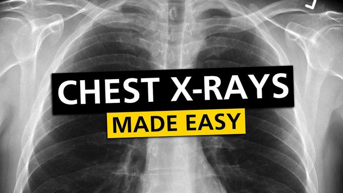 Chest X Rays (CXR)